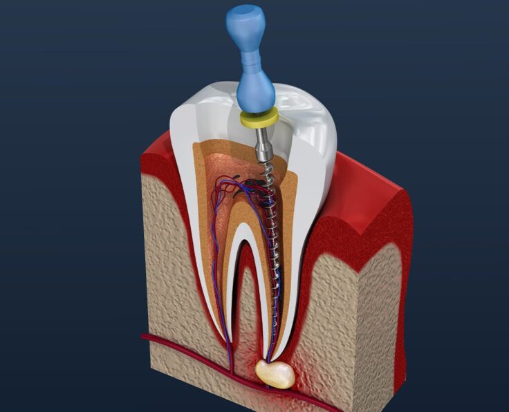 root-canal-treatment