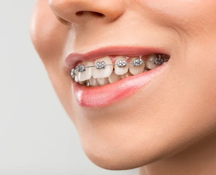 what-is-orthodontics-4