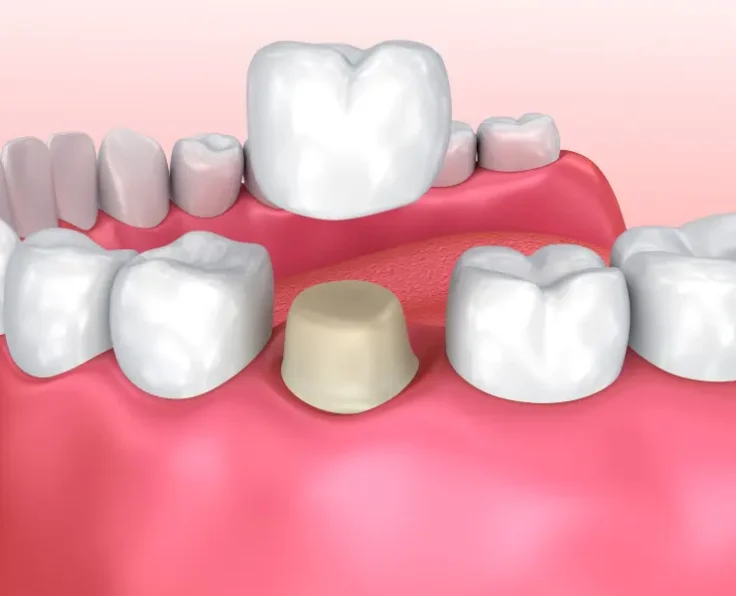 DentalCrown900x600.jpg