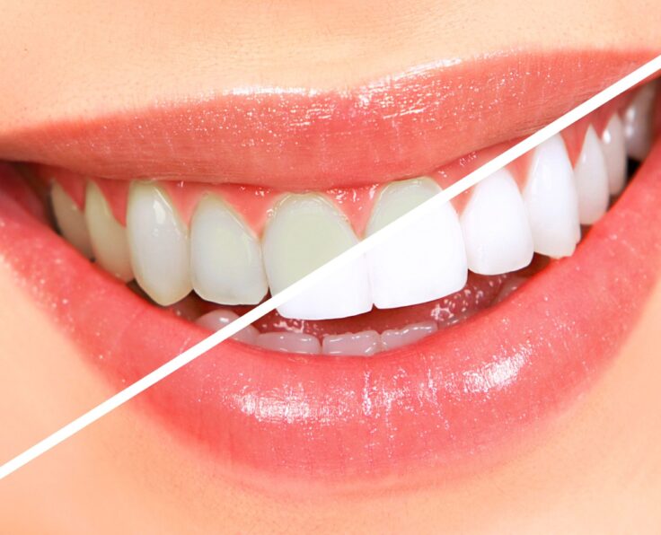 teeth-whitening-1_migrated